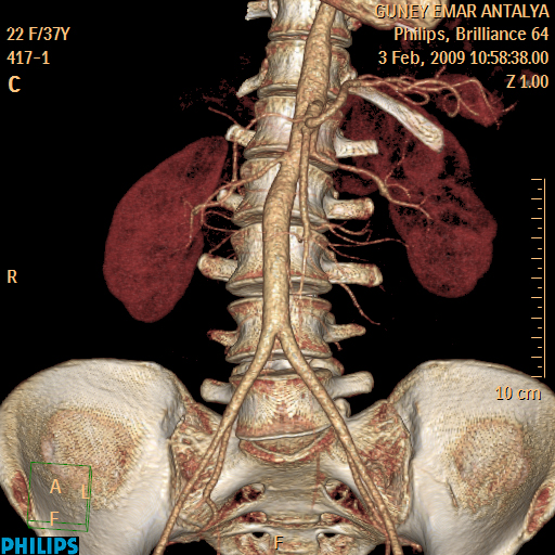 abdominal anjio