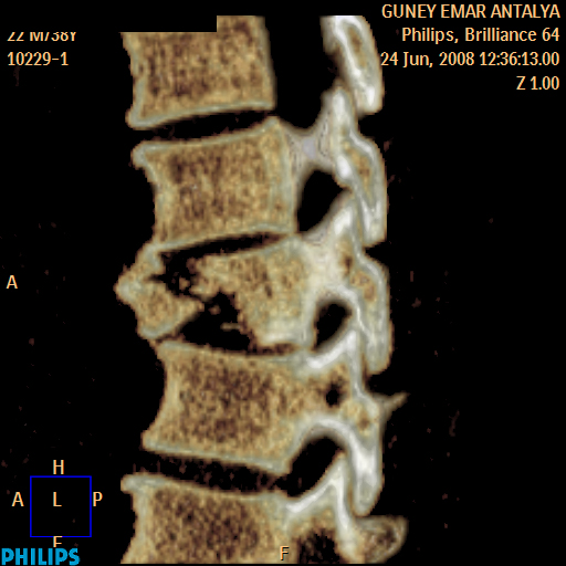 spinal bt
